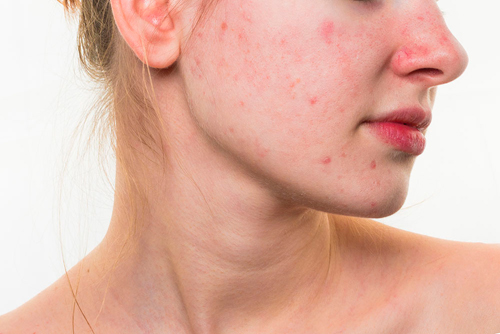 cremas anti acné efectivas