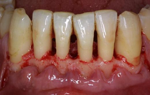 pasta dientes periodontitis